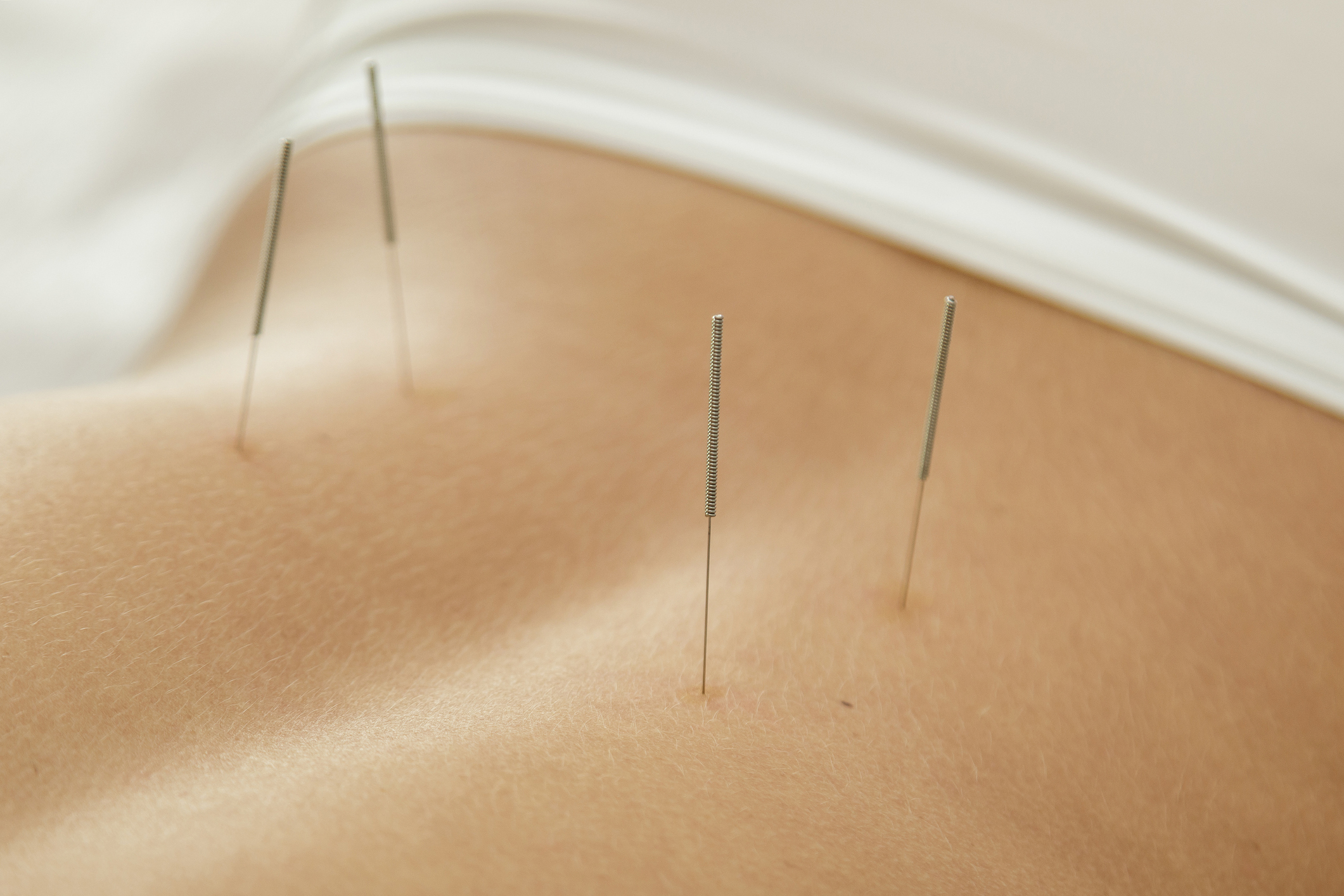 Back acupuncture